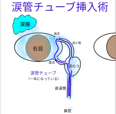 涙管チューブ挿入術 金沢文庫アイクリニック