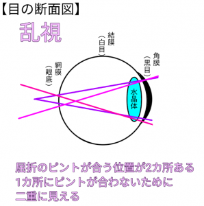 図解 近視手術 Icl と 近視 遠視 乱視のしくみ 金沢文庫アイクリニック