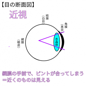 図解‼近視手術 ICL と 近視・遠視・乱視のしくみ | 金沢文庫アイ