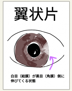 翼状片 黒目の上に白目が伸びてくる 金沢文庫アイクリニック